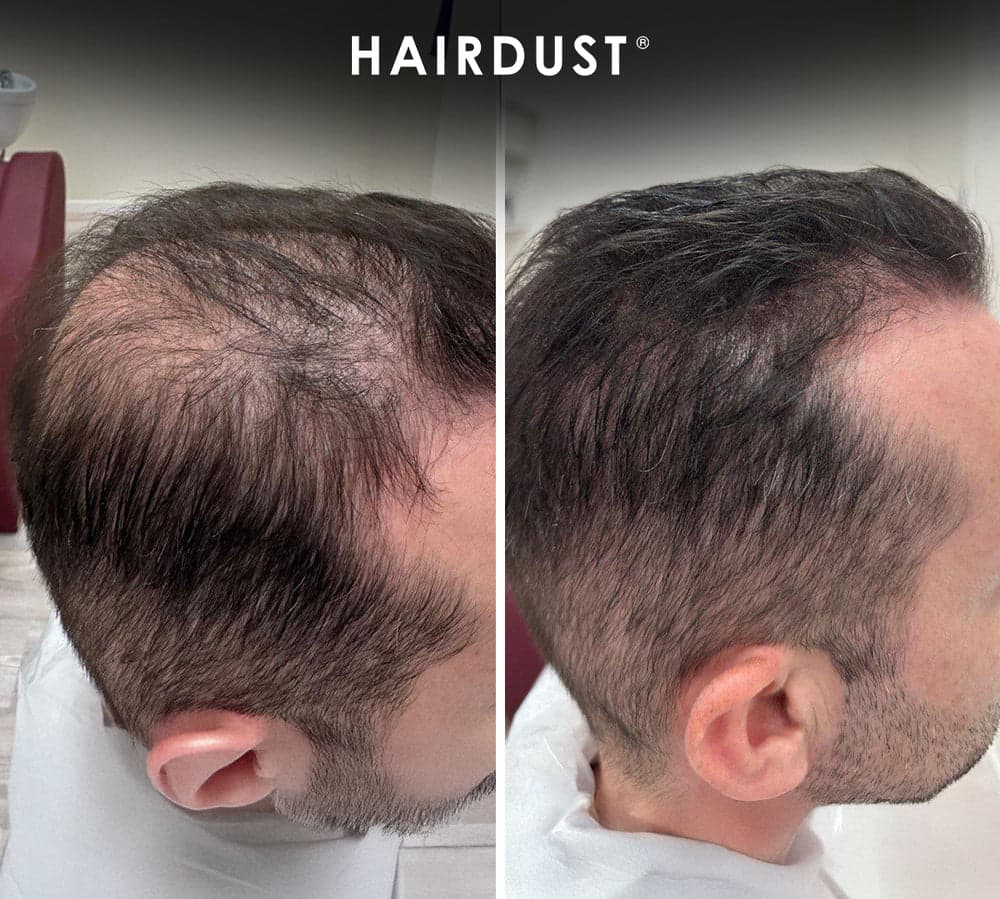 Prima e dopo HAIRDUST - stempiature